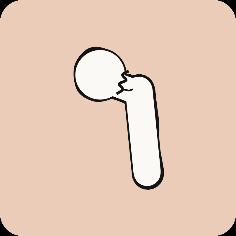 Illustration d'un fémur fracturé au col de la hanche, guide « Fracture de la hanche » en physiothérapie Physioactif