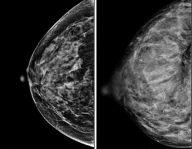What is a breast wire localization procedure