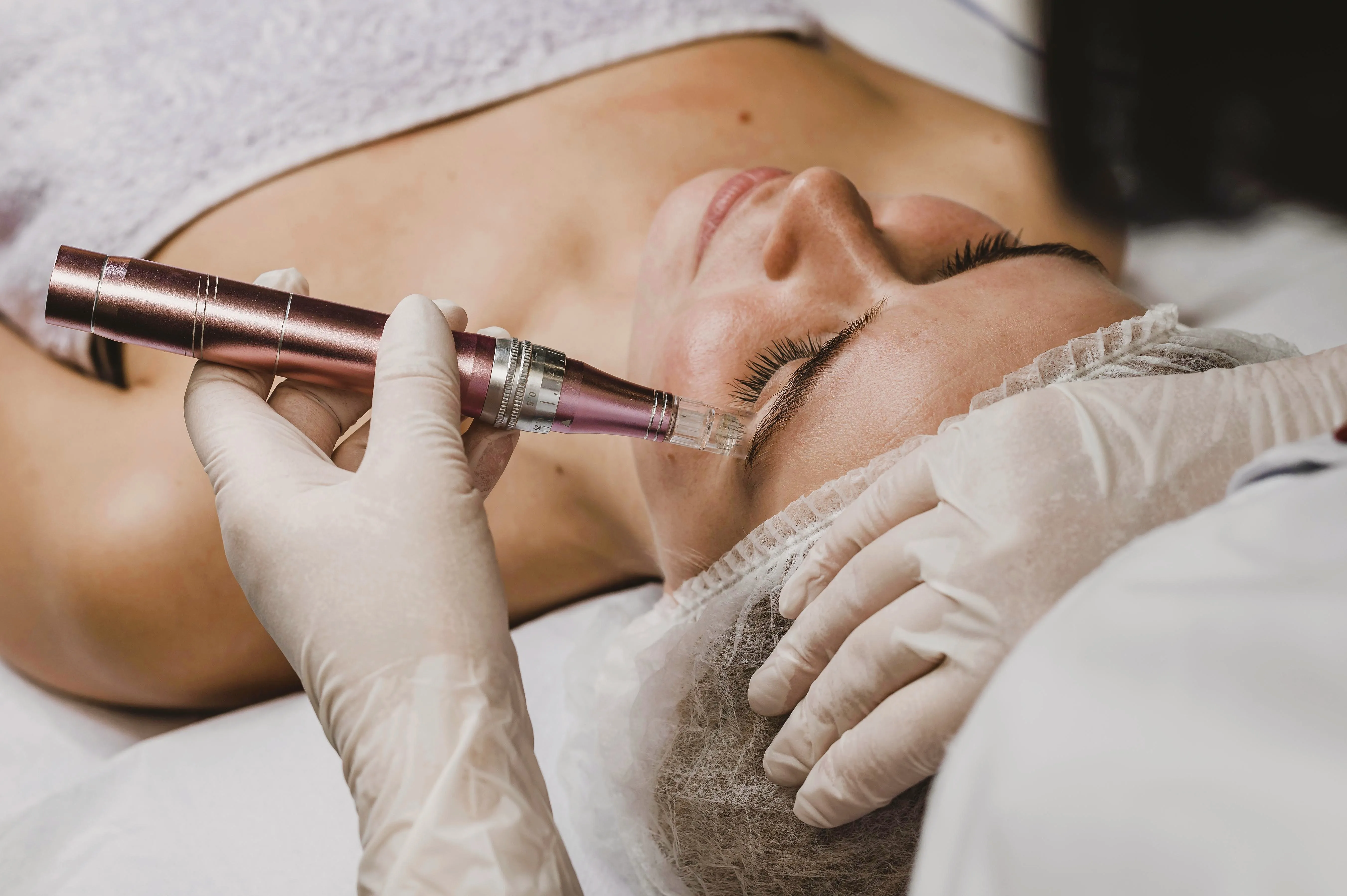 Microneedling treatment on a client's face at Sabi Skin Spa in Dallas