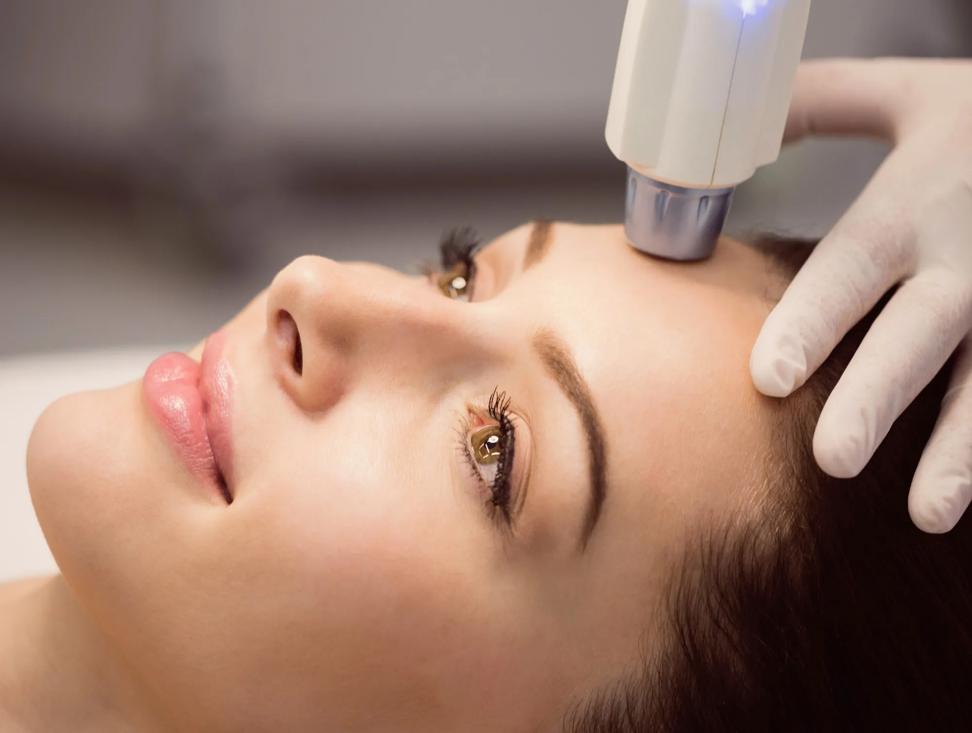 RF Microneedling