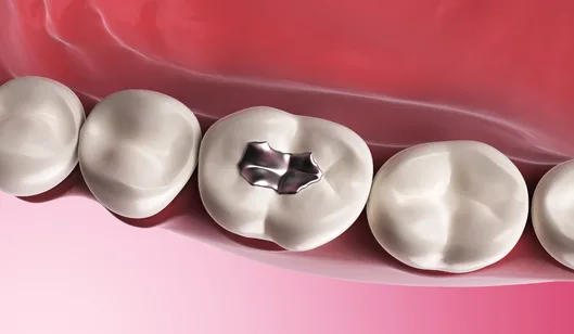 Dental Crowns in Renton, WA