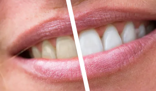 Dental Crowns in Renton, WA