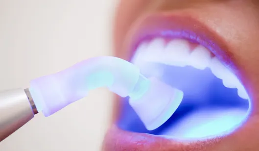 Dental Crowns in Renton, WA