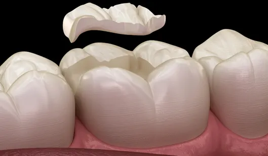 Dental Crowns in Renton, WA