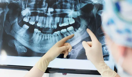 Dental Crowns in Renton, WA