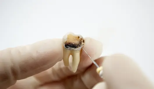 Dental Crowns in Renton, WA