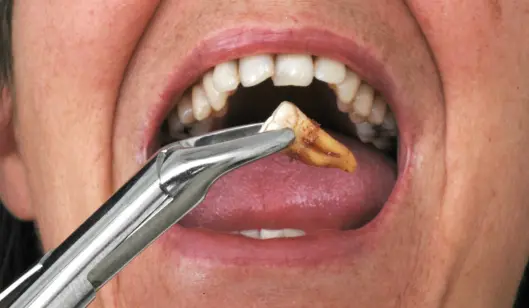 Dental Crowns in Renton, WA