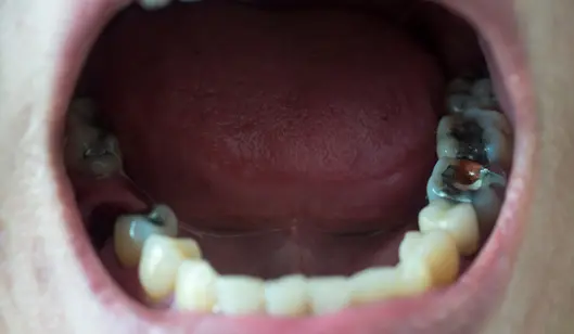 Dental Crowns in Renton, WA