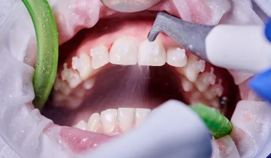 Dental Crowns in Renton, WA