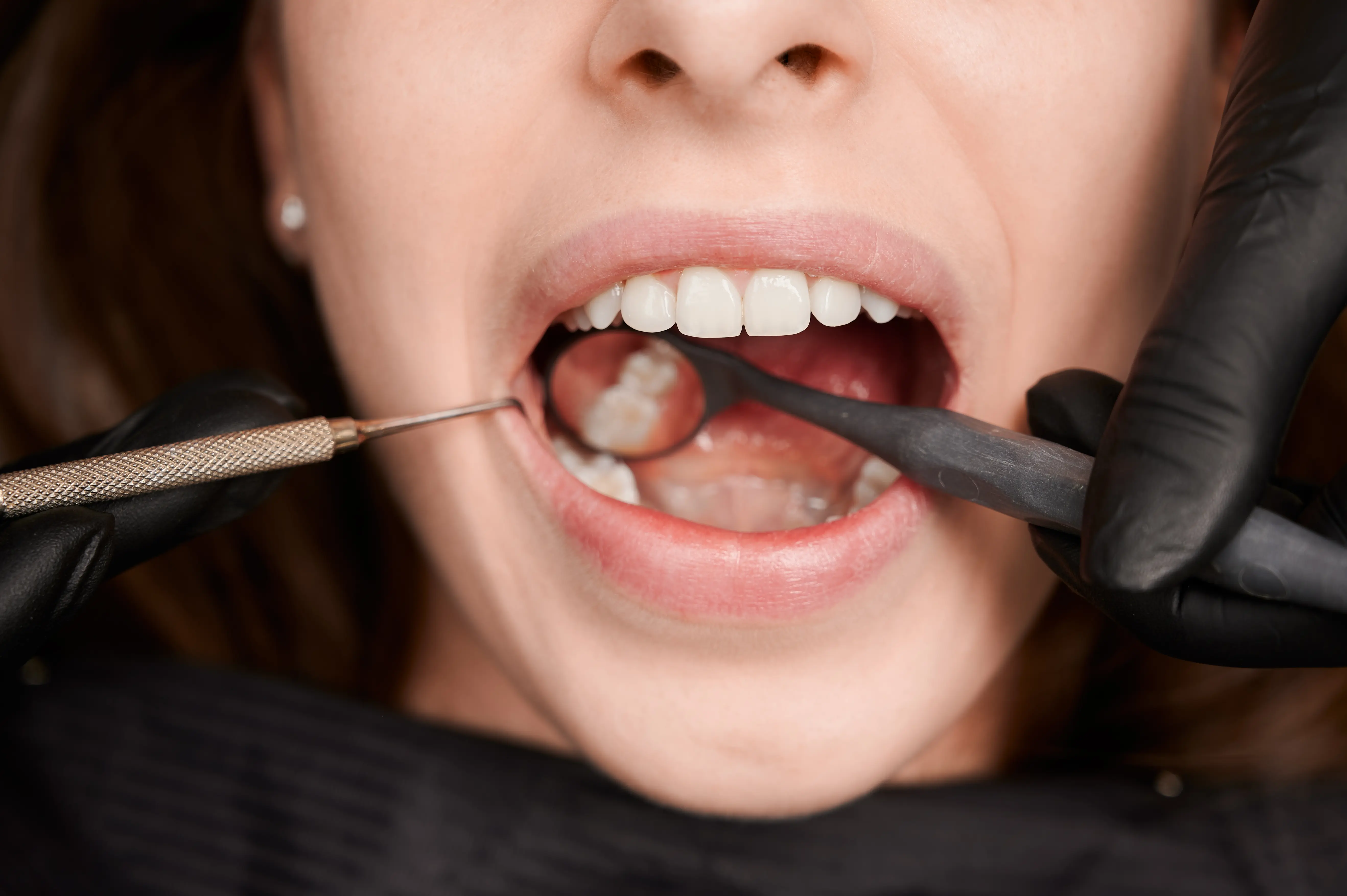 How Do I Know if My Wisdom Teeth Need to Be Removed?