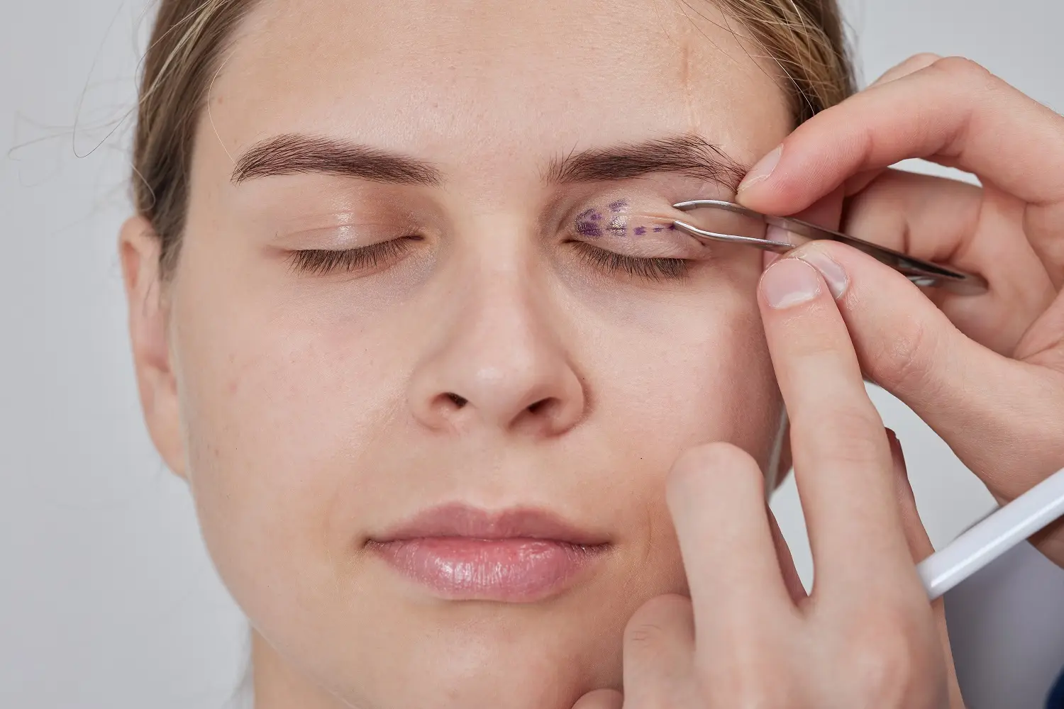Close-up of eyelid with medical condition