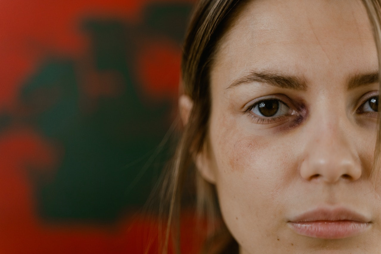 woman with a black eye