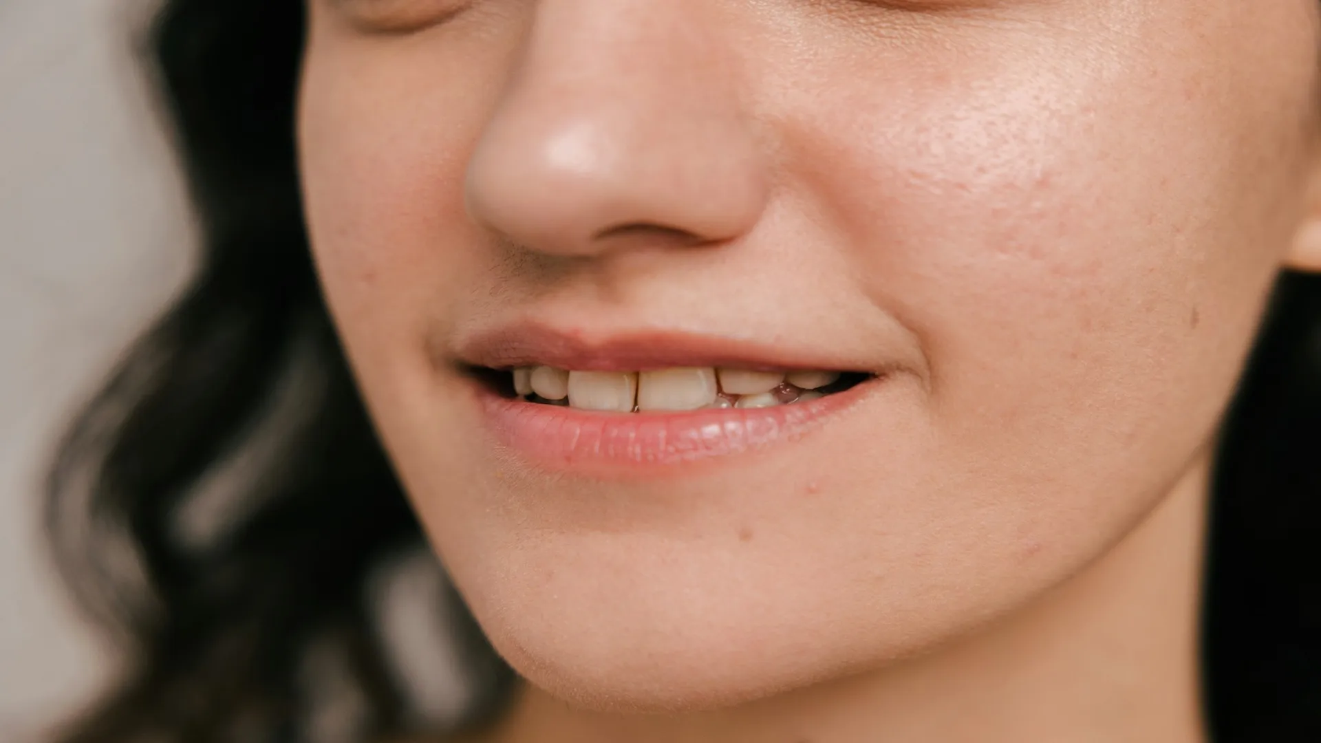 Addressing Chipped Teeth With Bonding and Veneers (What Works Best?)