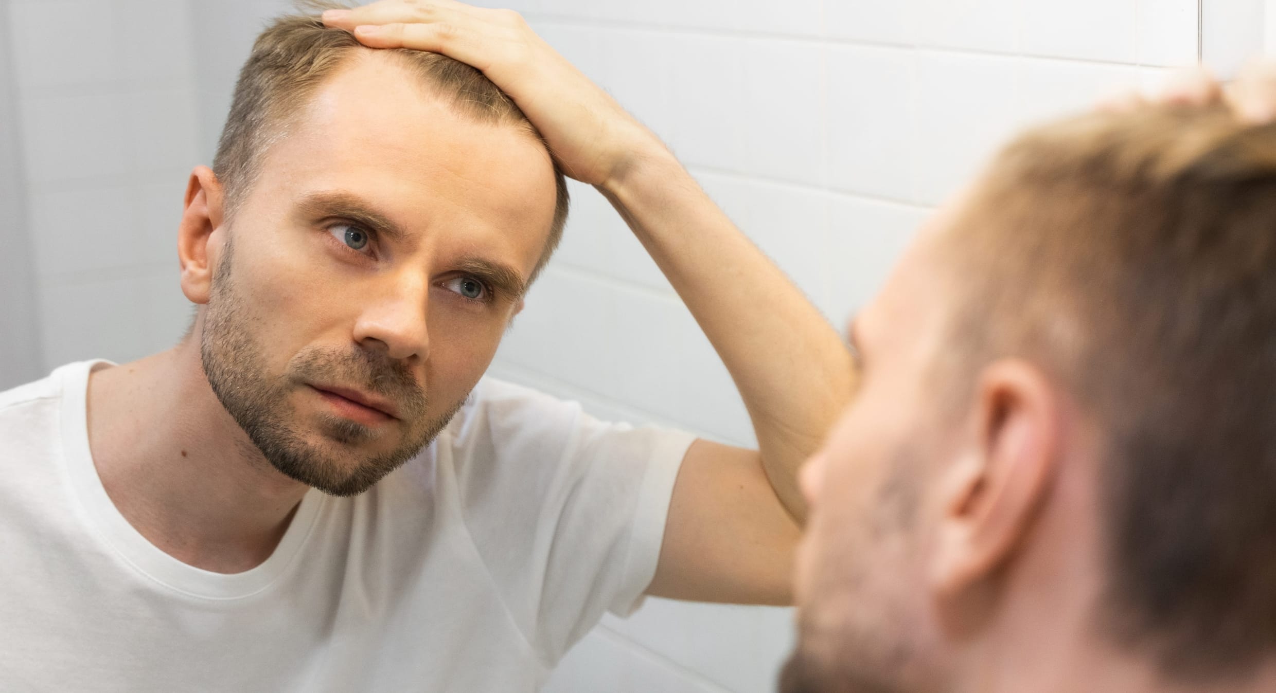 Haarverlust bei Männern