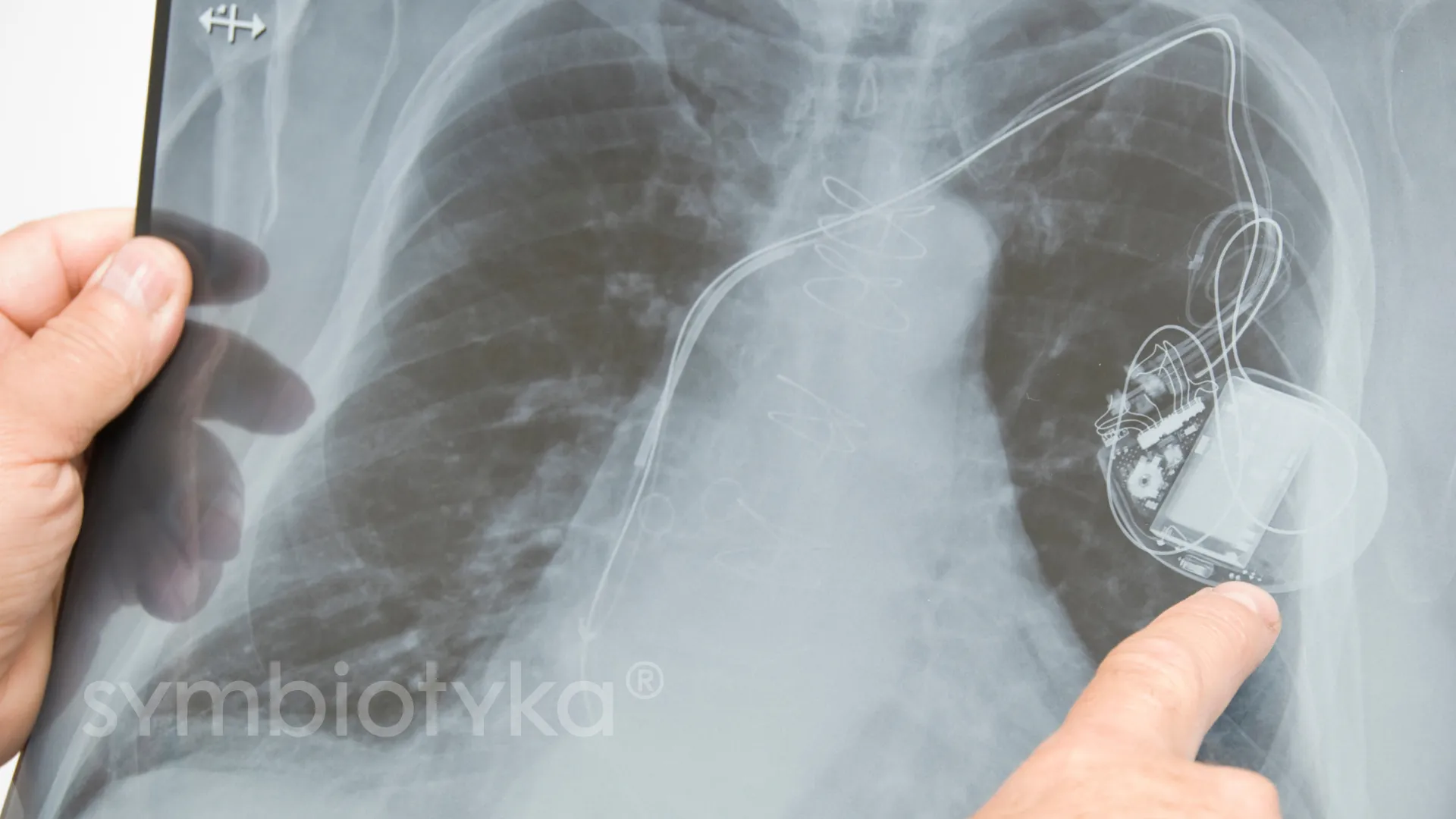 A person pointing at an x - ray of a lung.