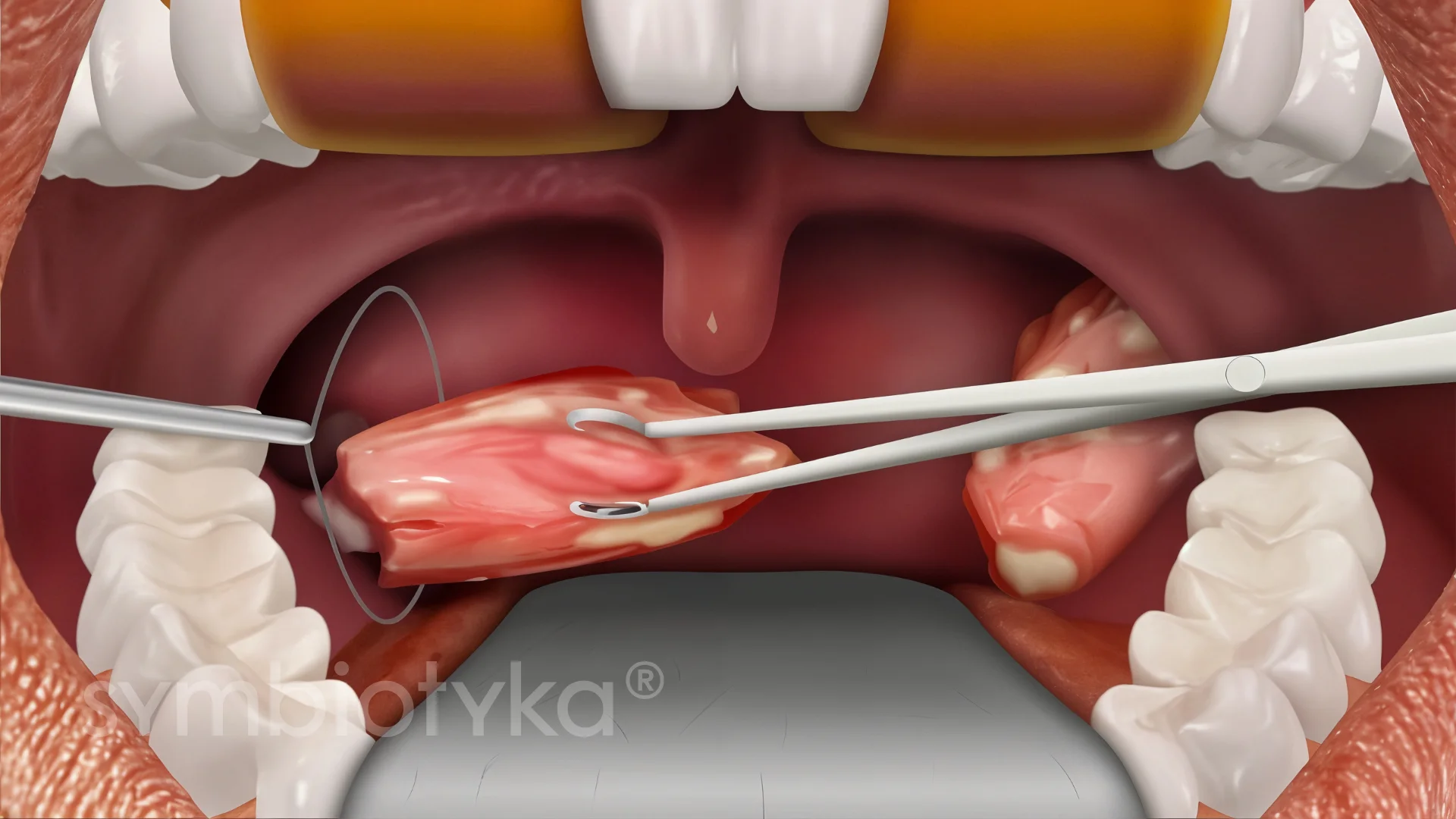 An illustration of a dental procedure being performed.