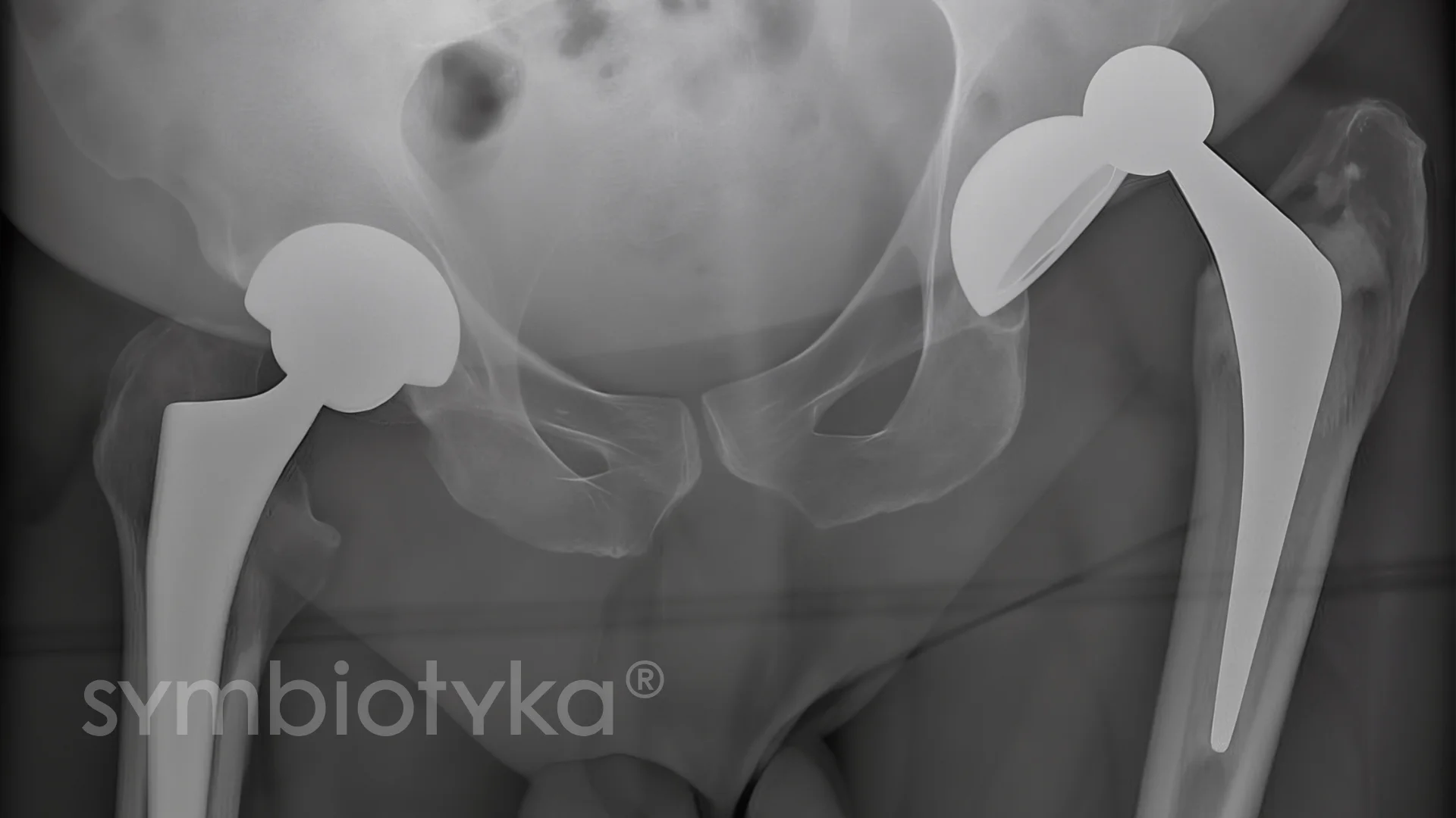 A black and white photo of the back of a person's stomach.