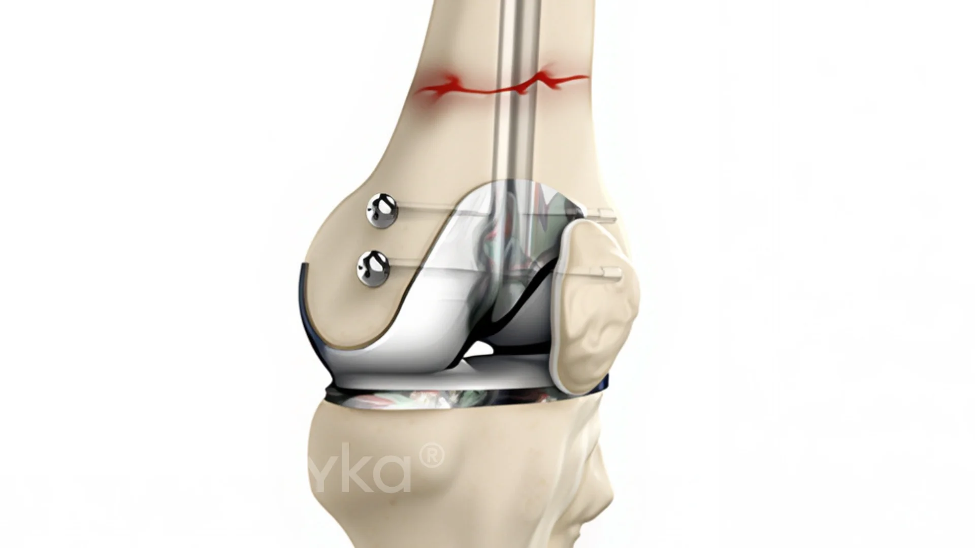 A medical illustration of a knee joint.