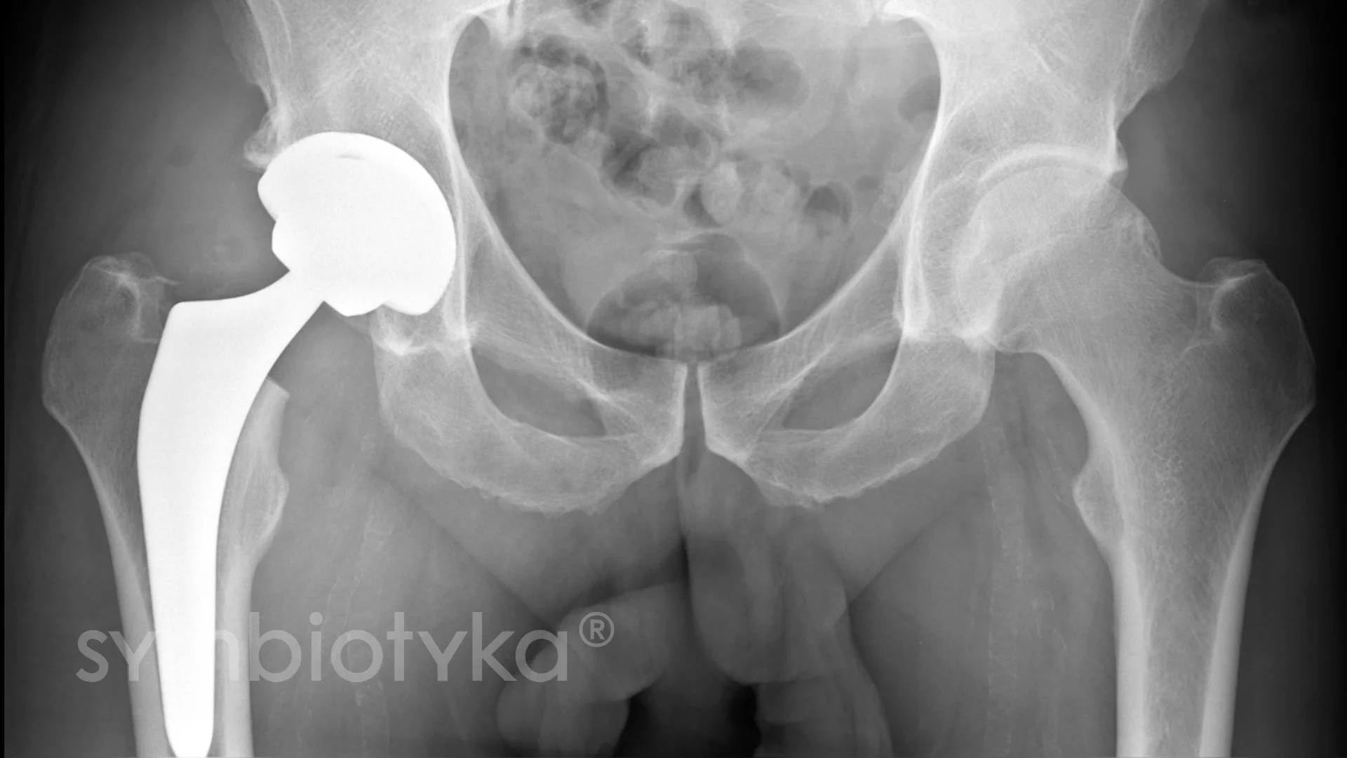 An x - ray image of a man's knee.