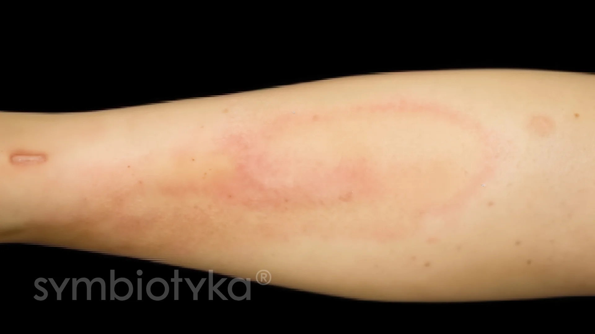 A close up of a person's arm with a red spot on it.