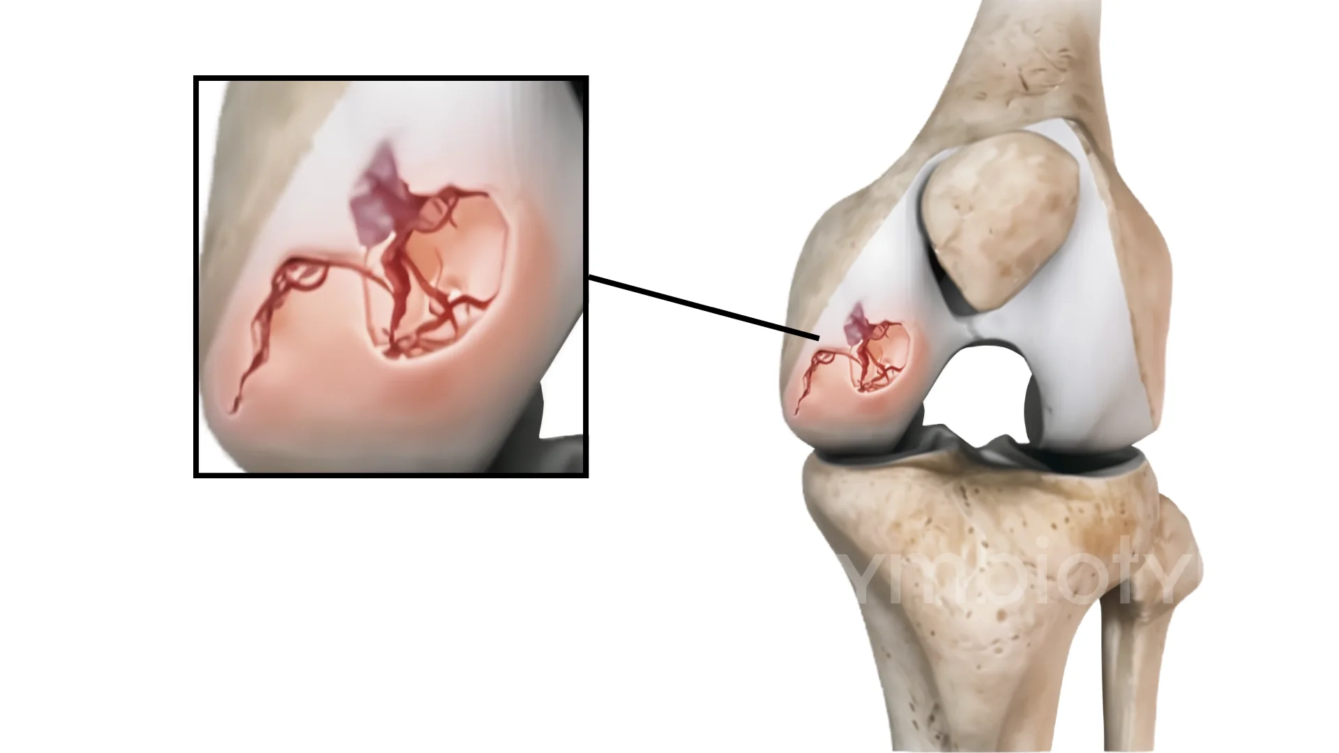 A picture of a knee joint with the knee joint removed.