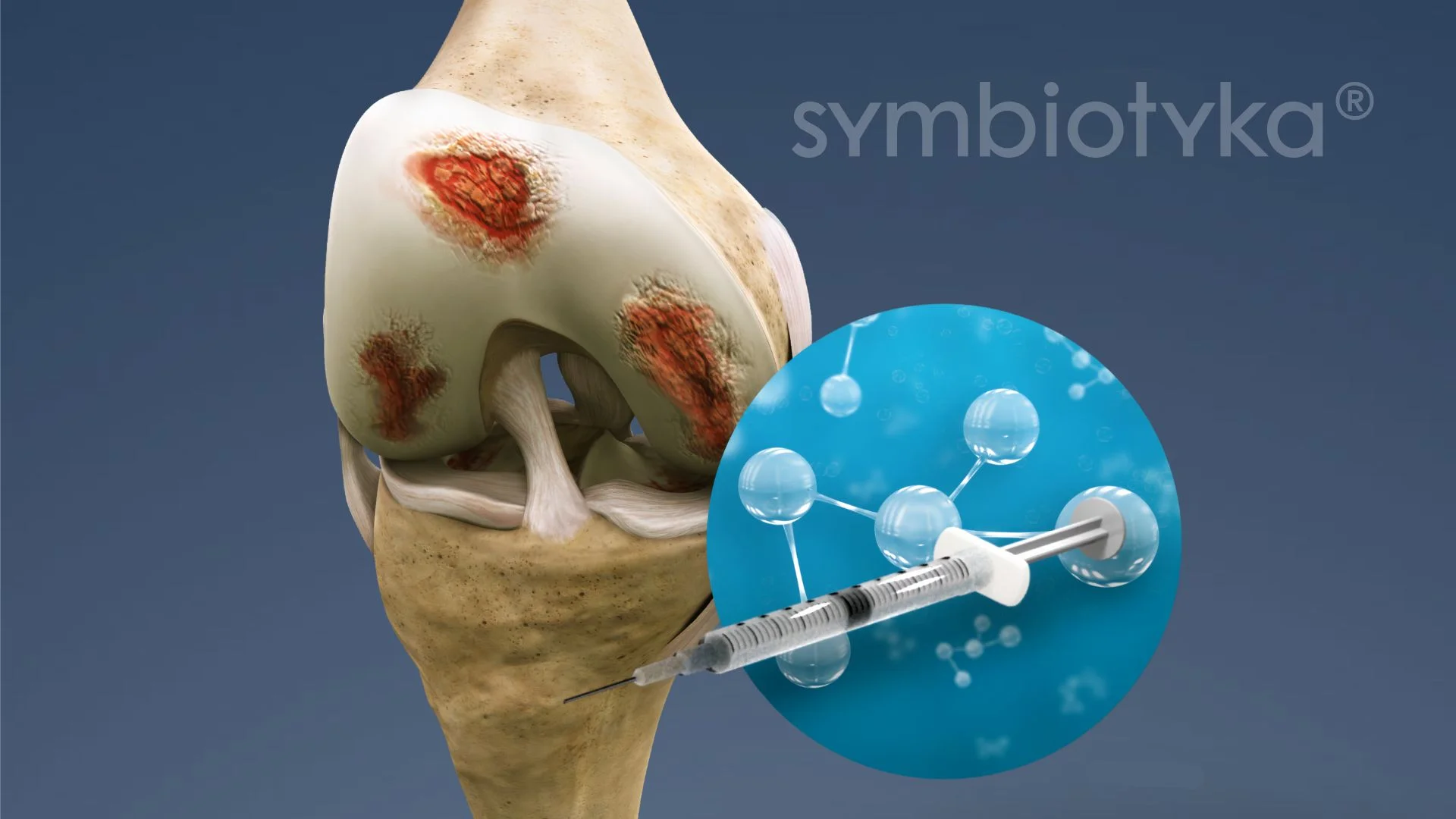 A medical model of a knee with a needle inserted into it.