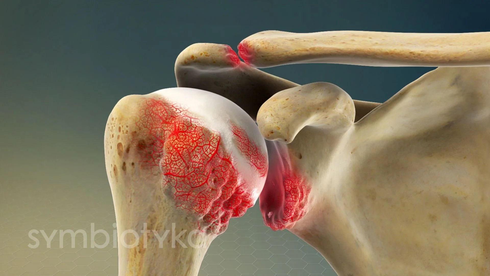A medical illustration of a shoulder with a red spot on it.