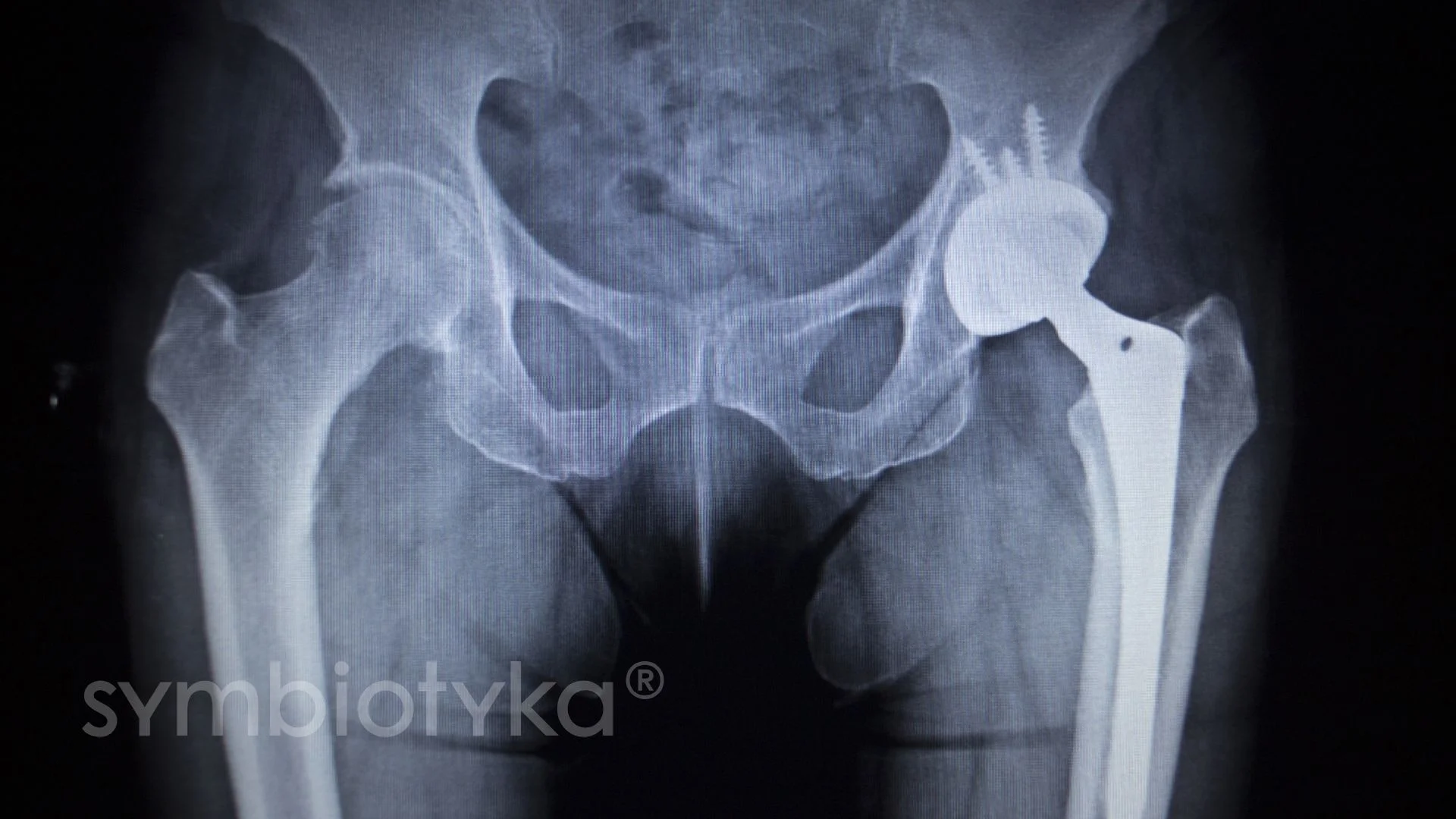 An x - ray of a knee with a large bone.