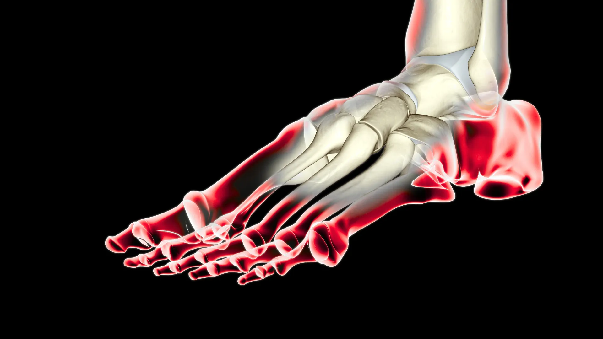 X-ray style image of a human foot skeleton with red highlights around the bones indicating inflammation or pain areas.
