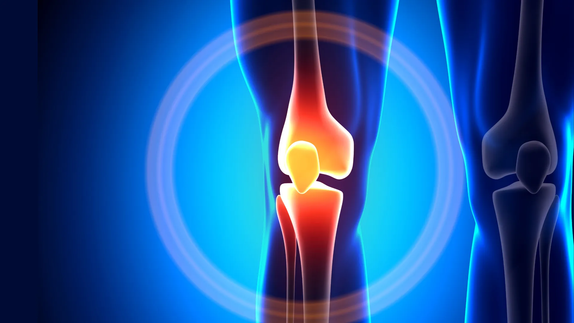 3D illustration of a human knee joint with highlighted inflammation in red and yellow.