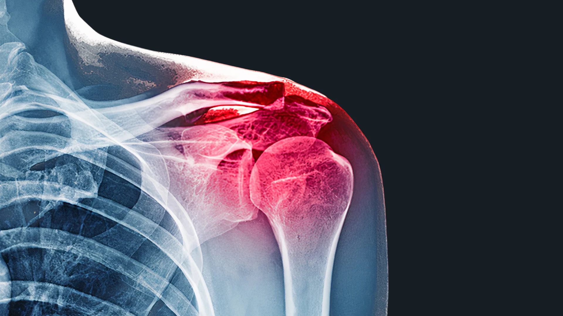 X-ray image of a human shoulder highlighting inflammation or injury in red around the joint.