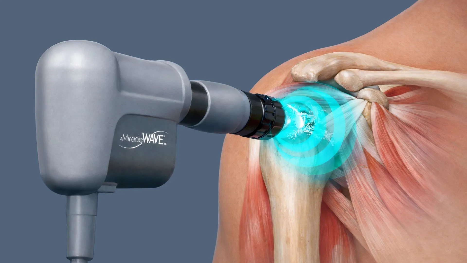 Medical device labeled MiracleWAVE applying targeted blue shockwave therapy to a human shoulder joint and surrounding muscles illustration.