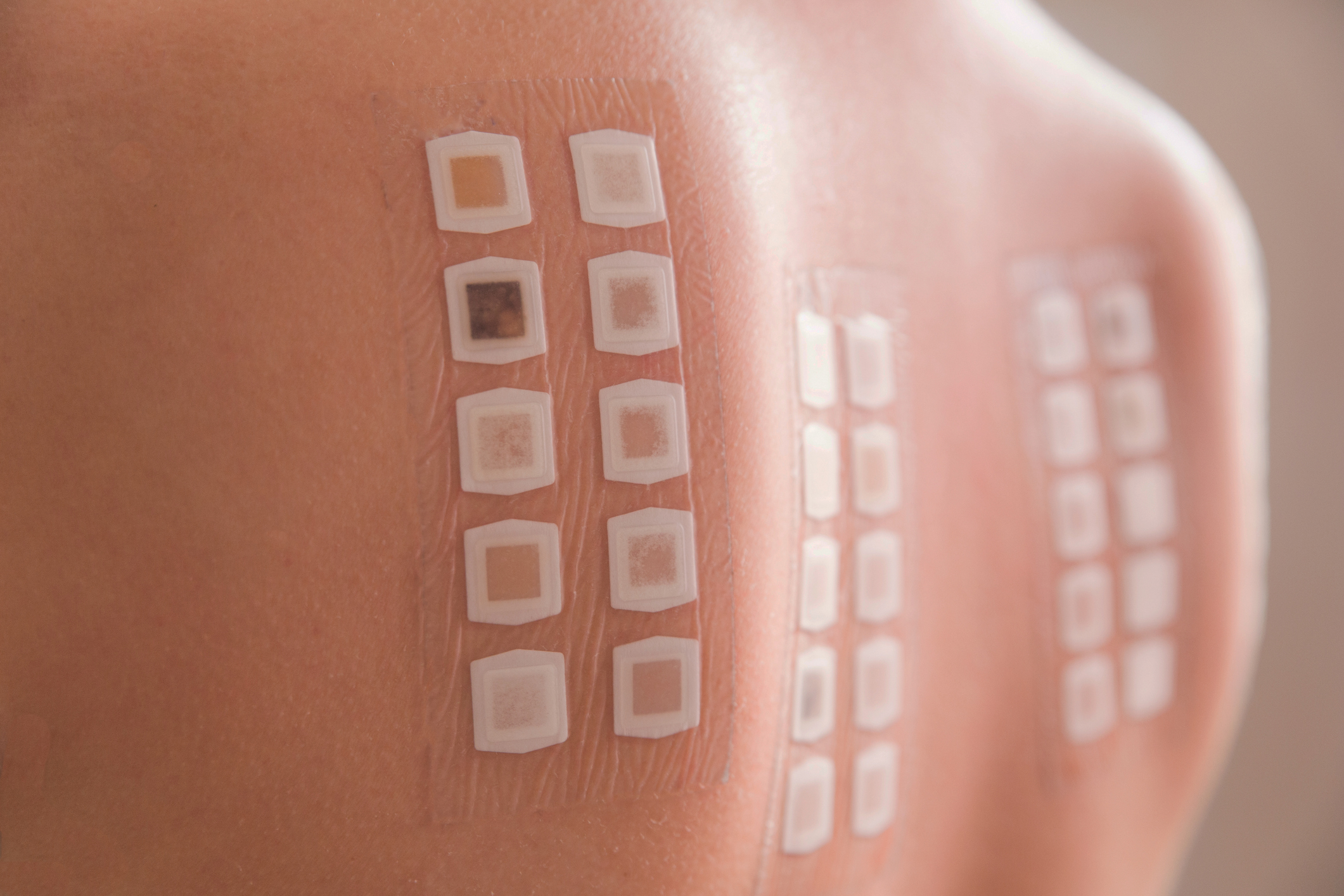 A person's back with skin patch testing applied.