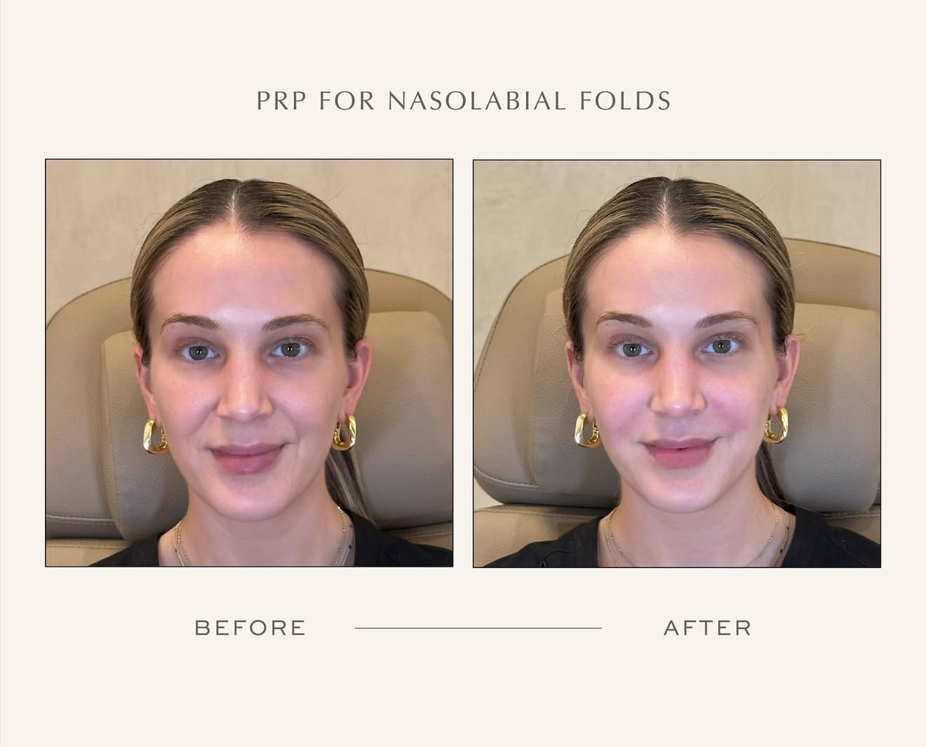 PRP hair growth chicago old town