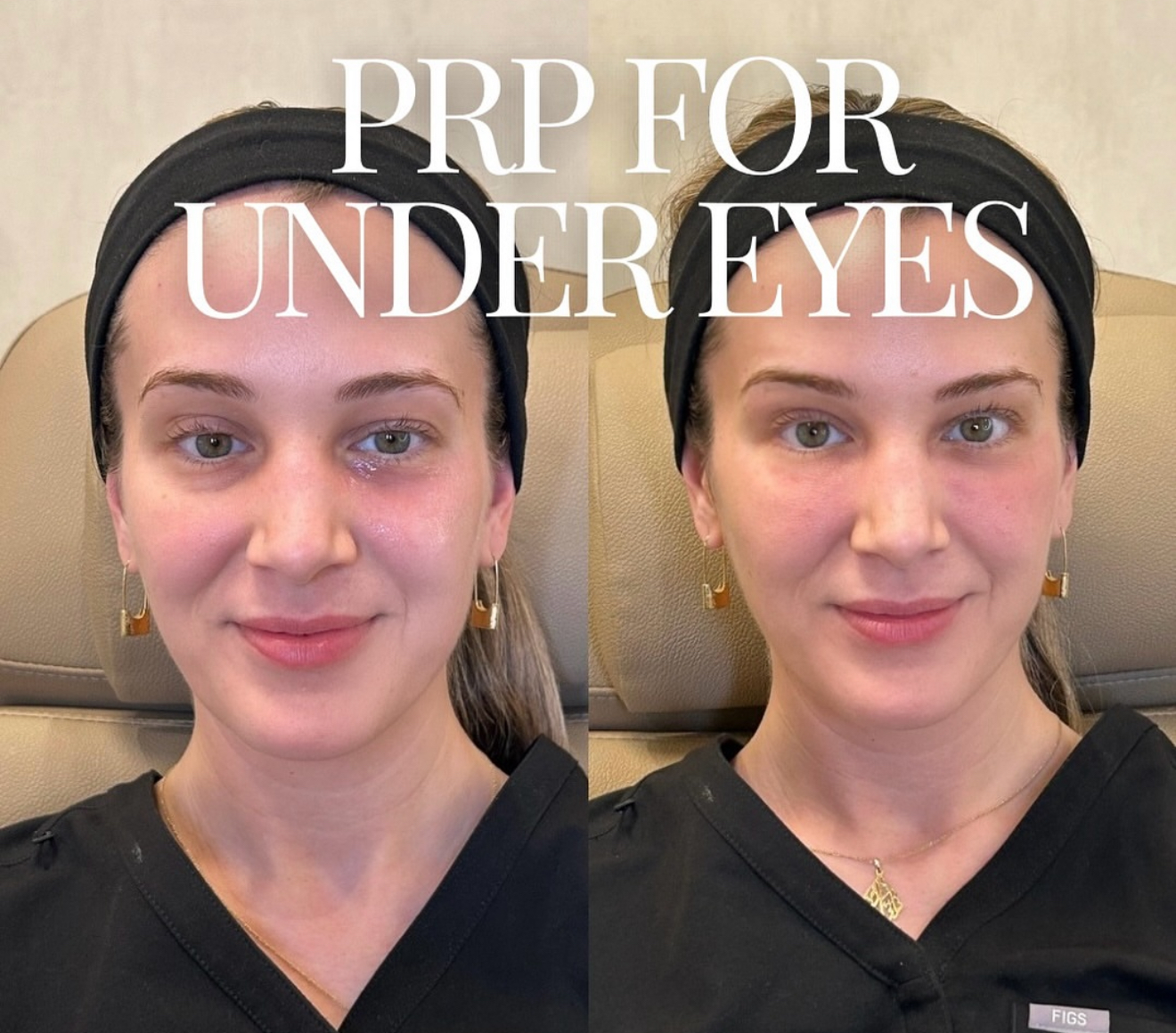 PRP hair growth chicago old town