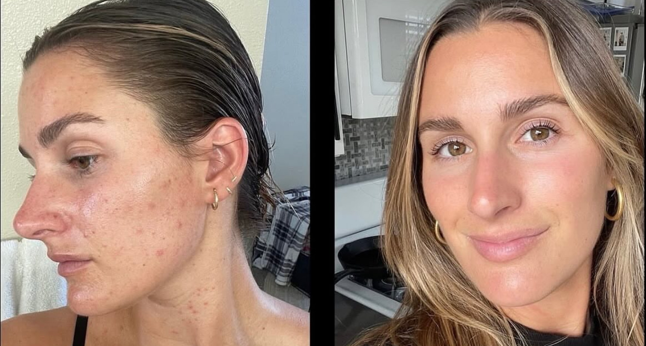 Chemical Peels for skin in Chicago Illinois Skin Bar and Studio