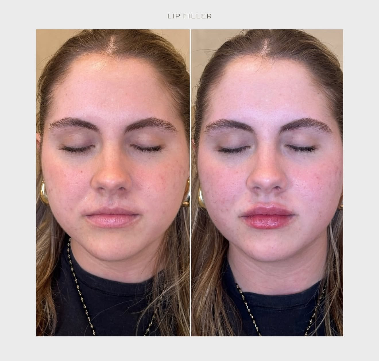 best lip filler in chicago old town skin bar and studio