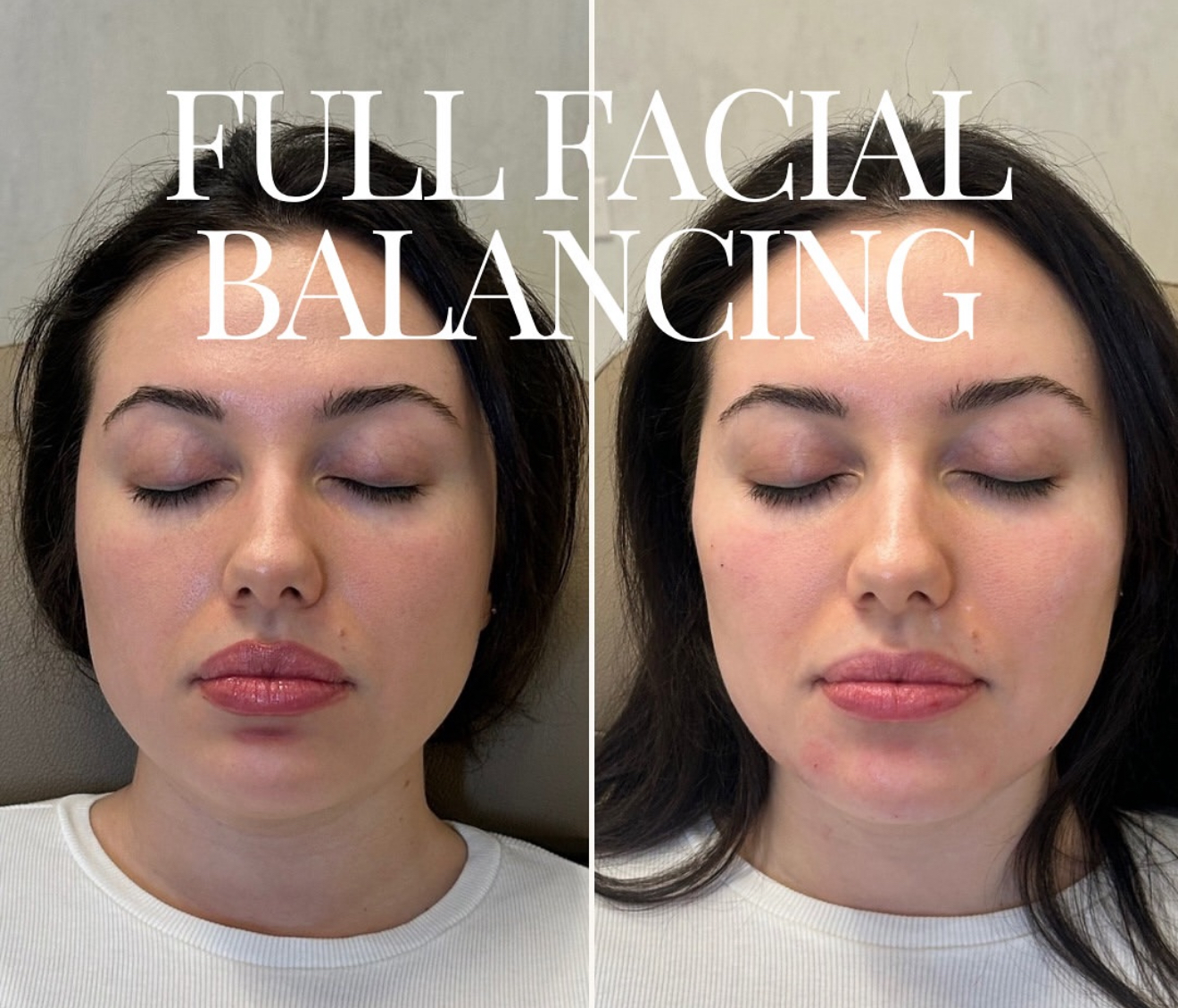 Best Dysport Botox Injectables in Chicago , Skin Bar and Studio Old Town