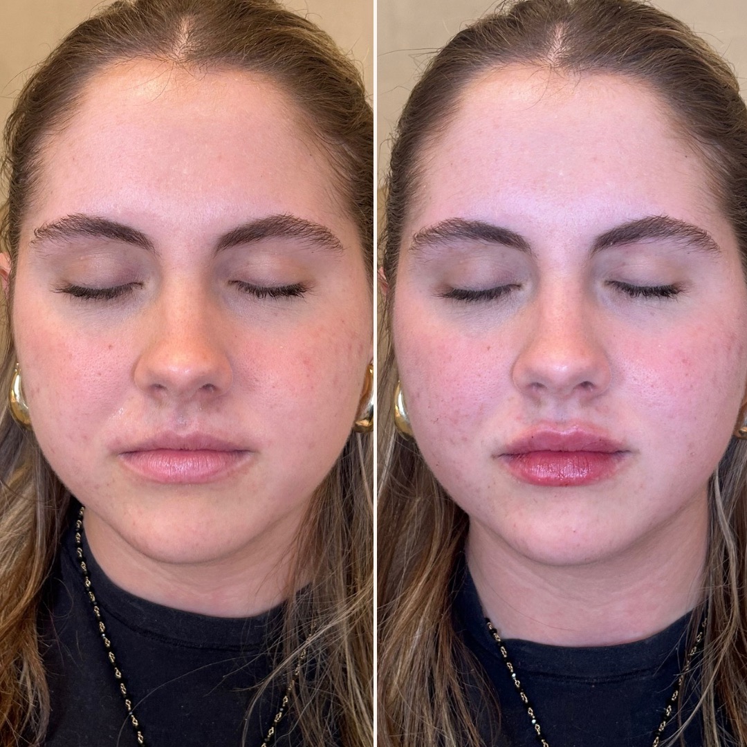 best lip filler in chicago old town skin bar and studio