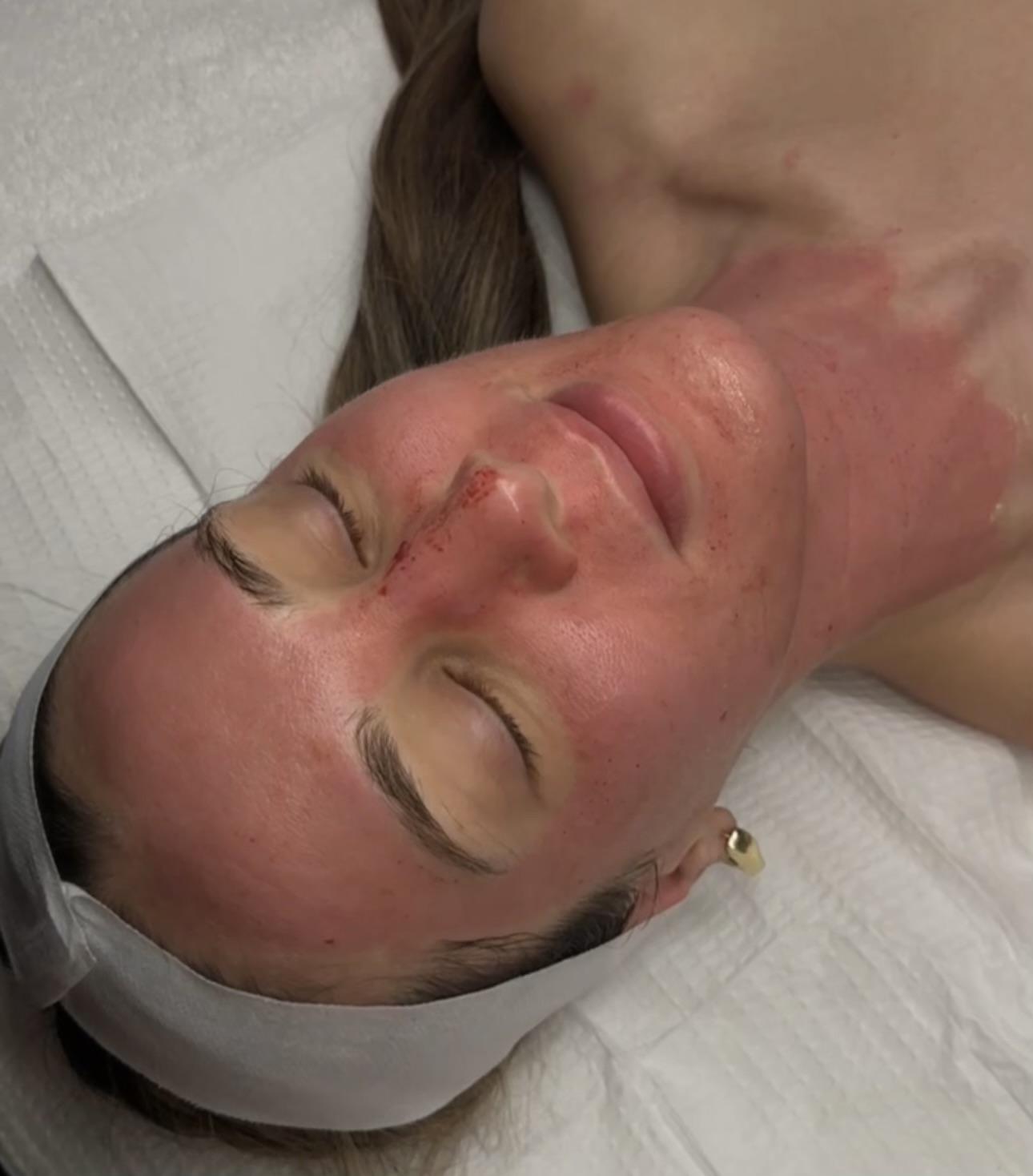 Vampire Facial Chicago Old Town Skin Bar and Studio