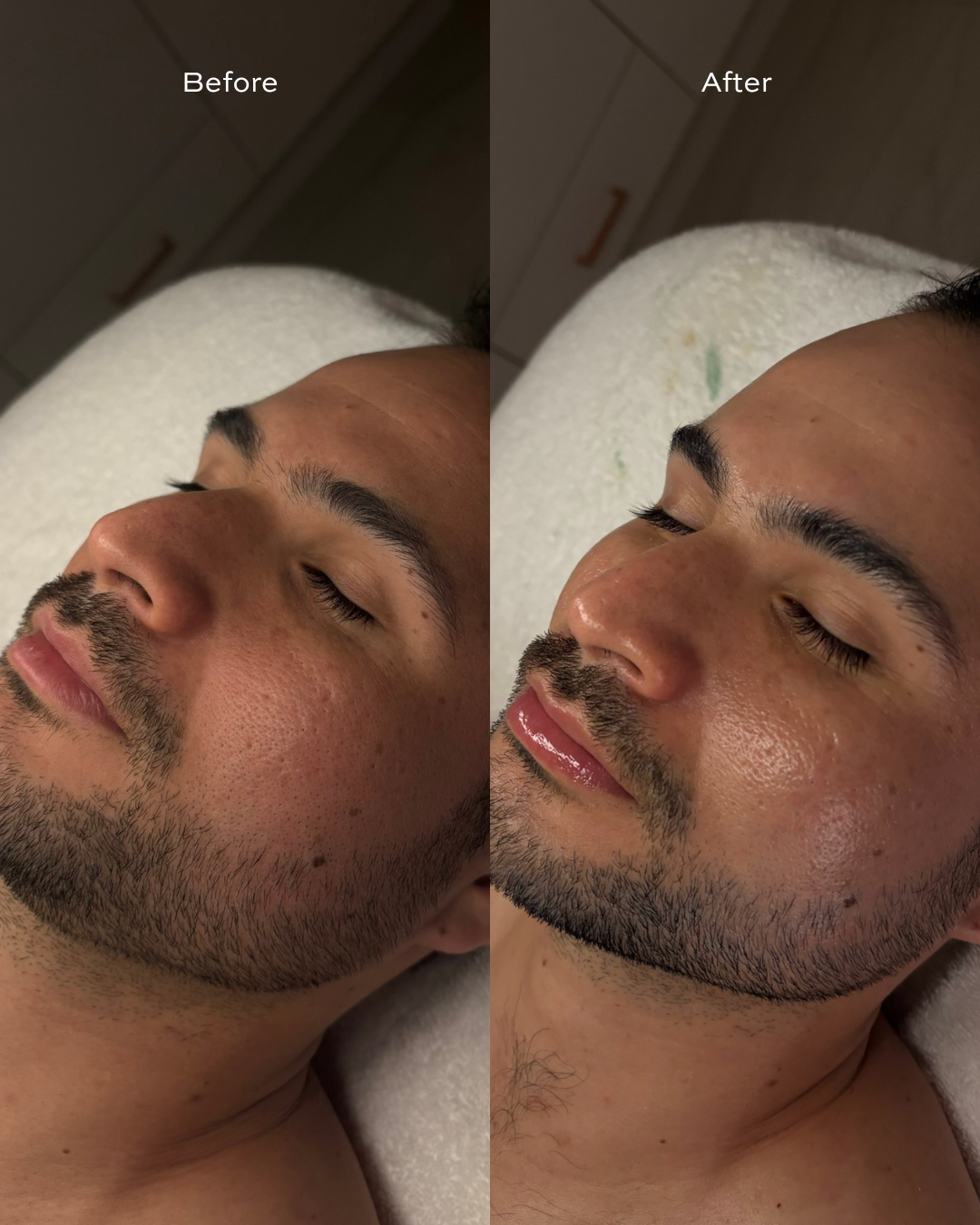 Best Hydrafacial Facial in Old Town Chicago Skin Bar and Studio