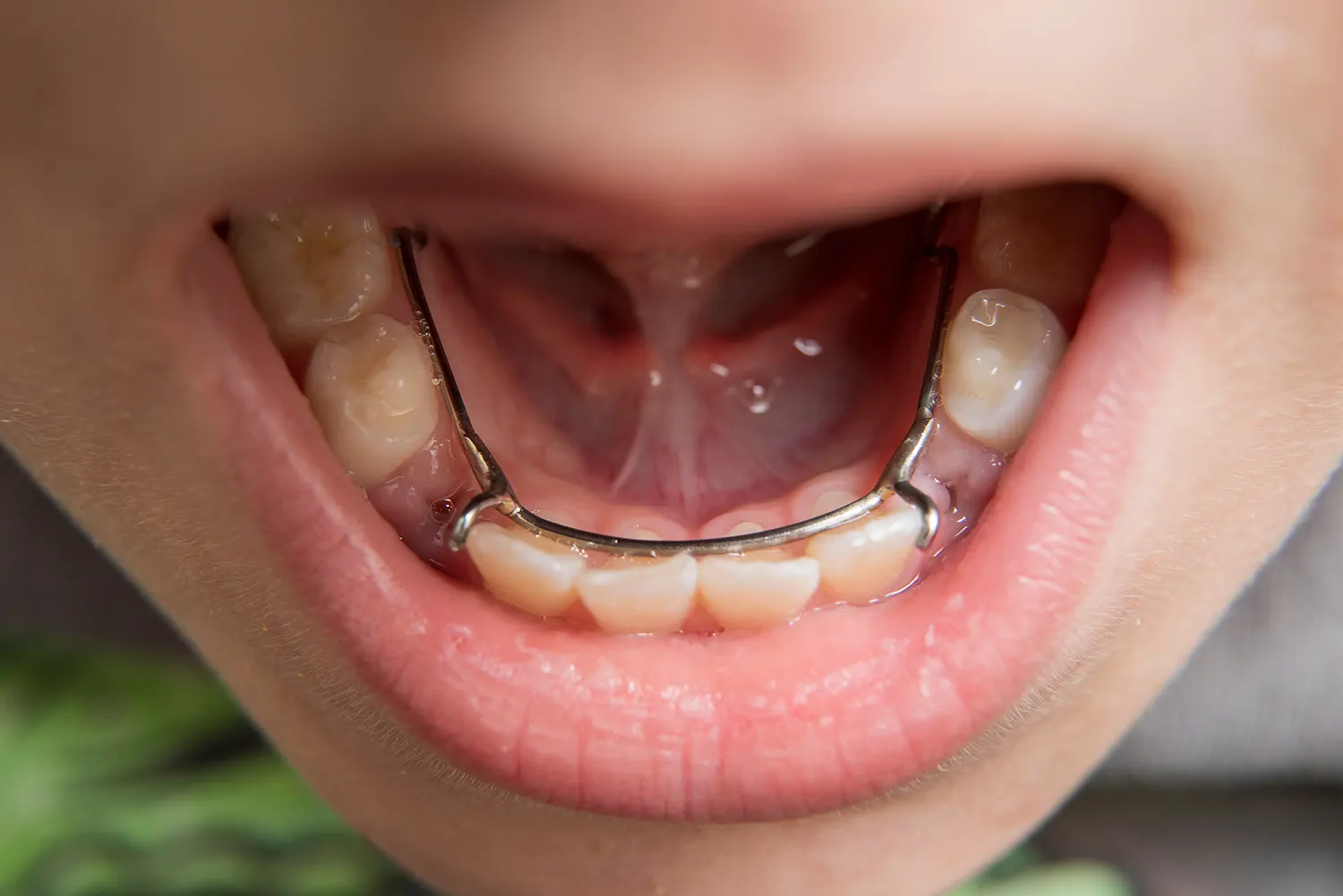 phoenix pediatric dental crowns