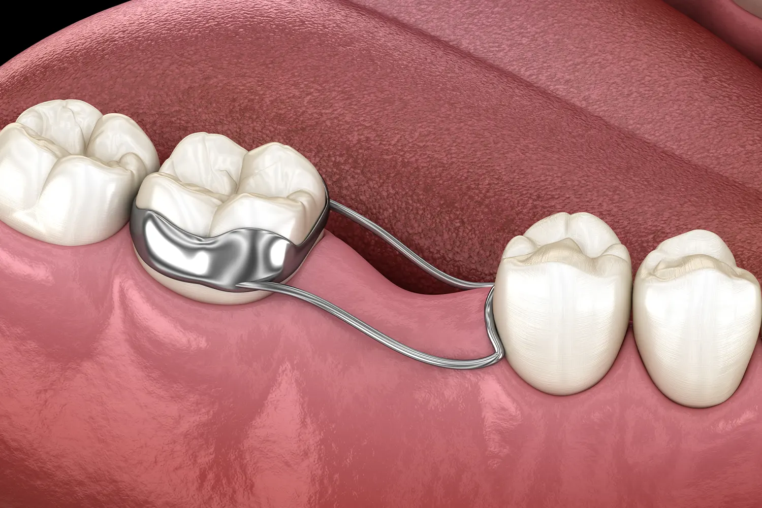 Space Maintainers: The "Traffic Controllers" of Your Child’s Smile