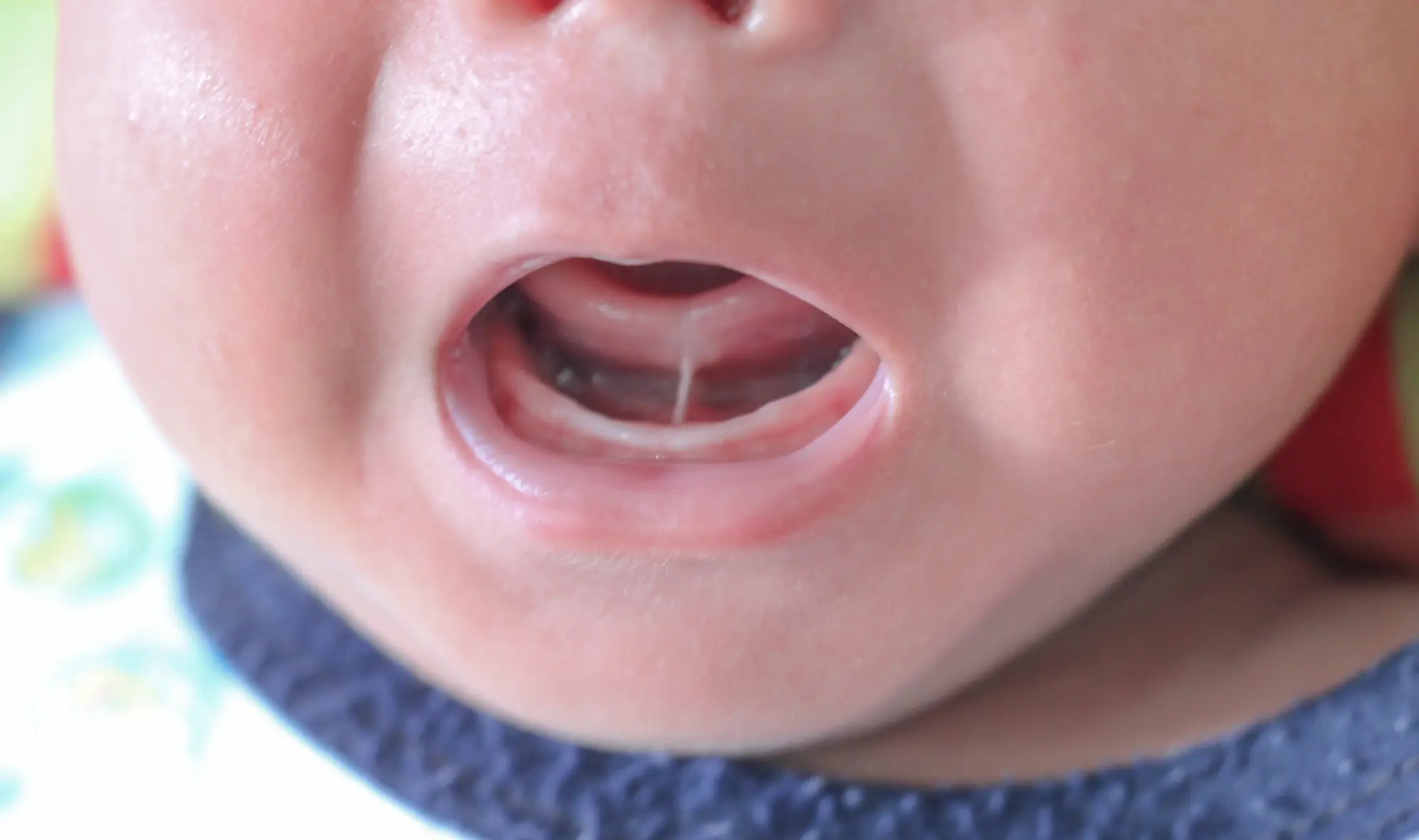 Frenectomy Surgery Near Mountain Ranch Park: What to Expect Before, During & After