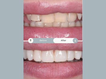 Perfect Smile Studio - Smile Makeover