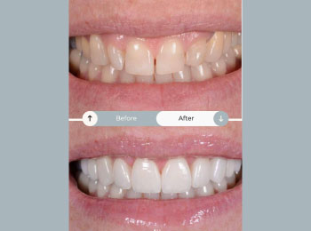 Perfect Smile Studio - Smile Makeover