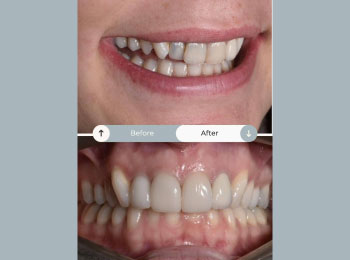 Perfect Smile Studio - Smile Makeover