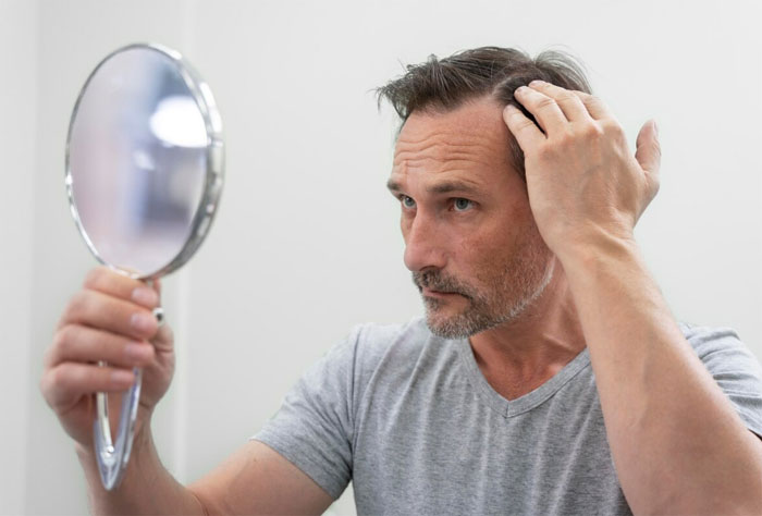 Alopecia in men