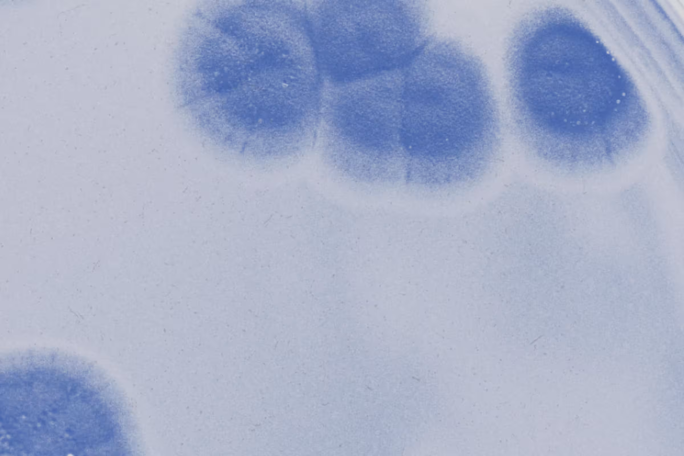 Trichomoniasis vs BV under the microscope