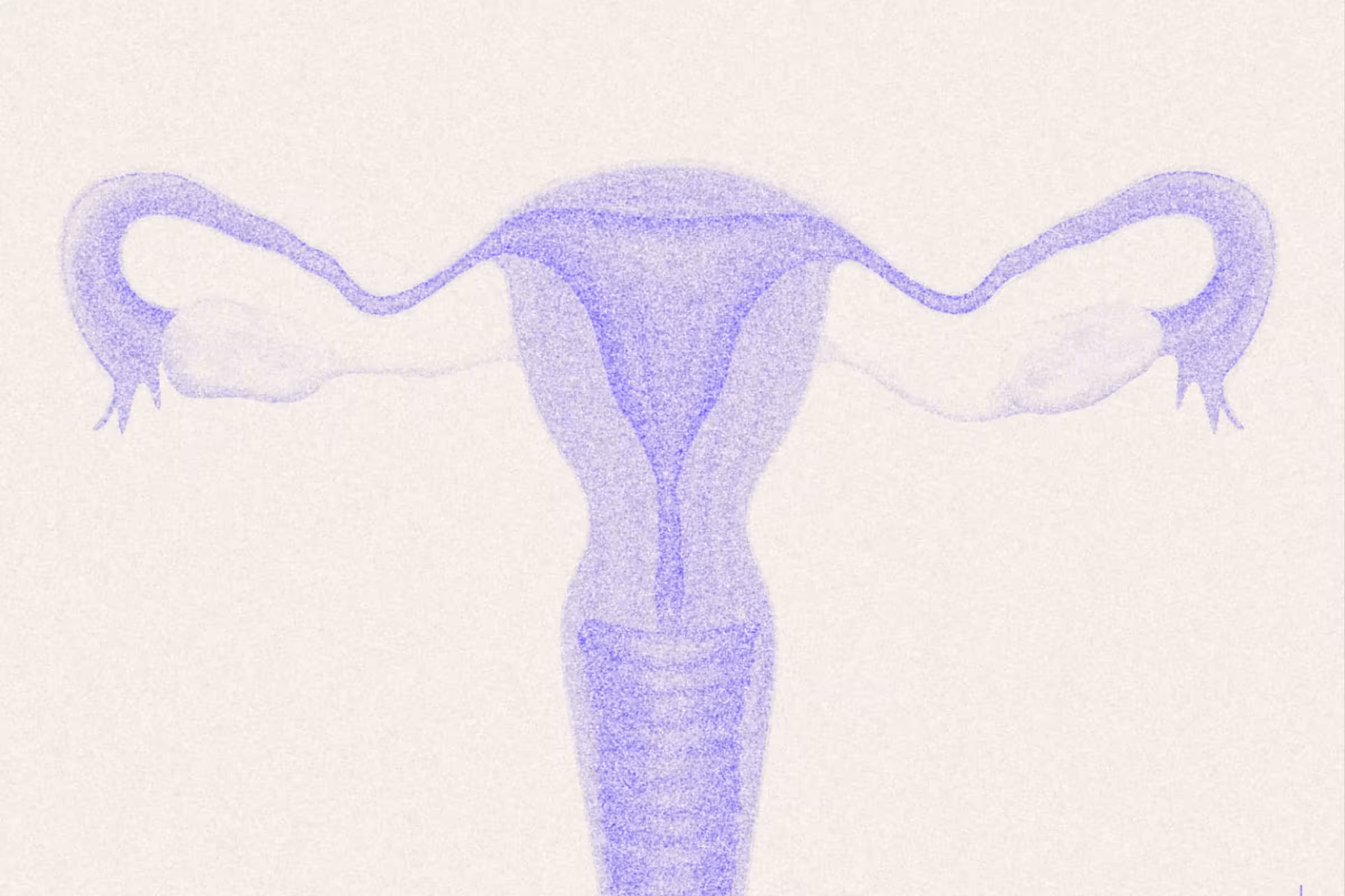 endometriosis